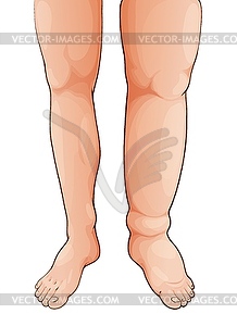 Edema lymphedema disease swollen leg and foot - vector clipart