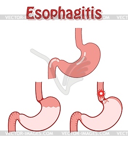 Human stomach in flat style. Disease esophagitis. - vector clip art