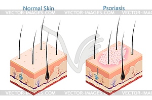 Cut human skin in isometric style Medicine problem - vector clipart