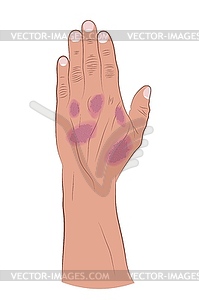 Psoriasis on human hand  - vector image