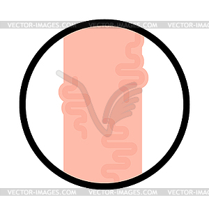 Varicose legs. Veins Disease of foot - vector image