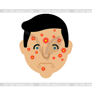 Acne on face man. Pimples on skin male - vector clipart