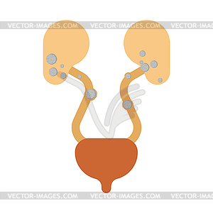 Stones in kidneys. Nephrolithiasis kidney stones - vector clipart