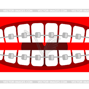 Braces on teeth. Open mouth and tooth - stock vector clipart