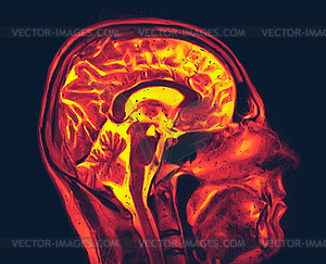 Magnetic resonance imaging of brain. MRI scan - vector clipart
