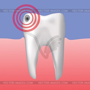 Hole in tooth - vector image