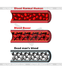 Blood vessel of healthy person with normal - vector clipart