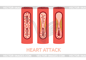 Heart attack symptoms - vector clip art