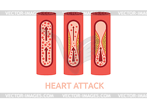 Симптомы сердечного приступа - рисунок в векторе