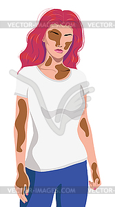 Girl with vitiligo in white t shirt - vector image