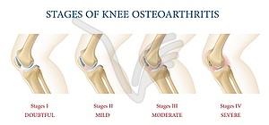 Инфографика стадий остеоартрита коленного сустава - изображение в векторе