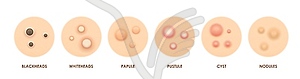 Body skin acne types, pimples, pore inflammation - vector clipart