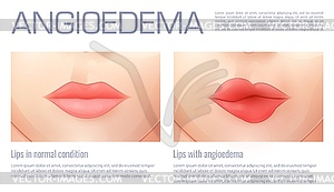 Swollen lips of angioedema or edema swelling - vector image