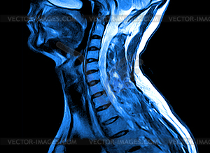 Magnetic resonance imaging of cervical spine - vector image
