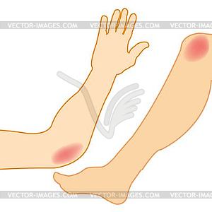 Hand and leg pain - vector image