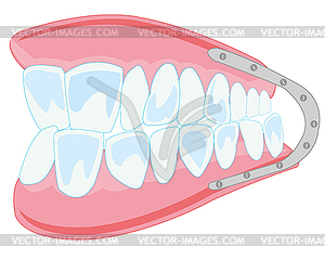 Denture is insulated - vector clipart