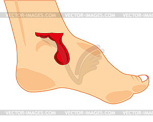 Blood wound on leg of person - color vector clipart