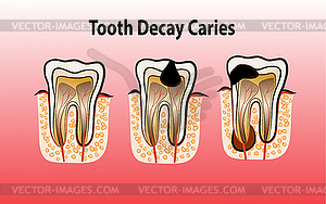 Кариес Кариес - векторная графика