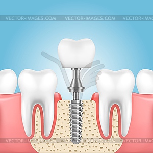 Tooth dental implant, dentistry denture technology - vector clipart