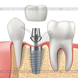 Teeth, dental implant realistic , dentistry - vector image