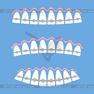 Medical Braces Teeth. Dental Care Background. - vector clipart / vector image