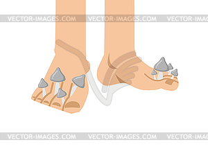 Fungus on feet. Mycosis between fingers. Disease - vector clipart