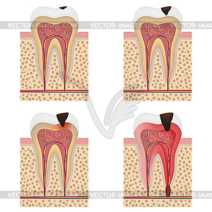 Development of dental caries  - vector image