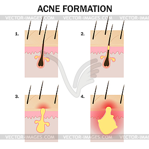 Formation of acne - color vector clipart