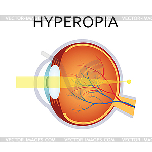 Hyperopia eyesight disorder - vector image