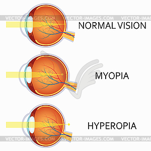 Optical human eye defects. Myopia and hyperopia - vector clipart