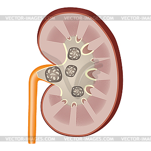 Kidney stones  - vector clipart