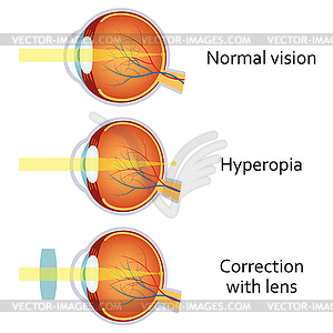 Hyperopia corrected by plus lens - color vector clipart