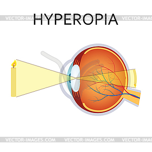 Hyperopia eyesight disorder - vector clip art