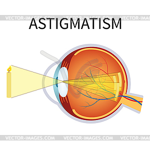 Astigmatism - vector image