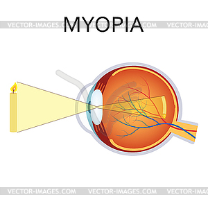 Myopia - vector image