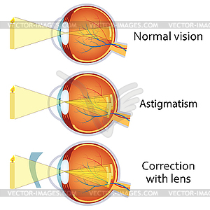 Astigmatism corrected by cylindrical lens - vector clip art