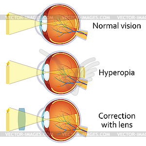 Hyperopia corrected by plus lens - vector image