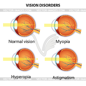 Common vision disorders - vector clipart