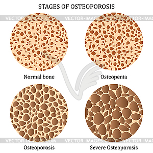 Stages of osteoporosis - vector clip art