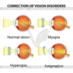 Correction of eye vision disorders by lens - vector clipart