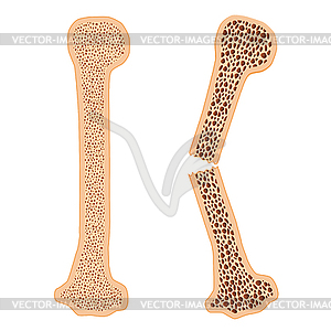 Healthy bone and broken bone with osteoporosis - vector clip art