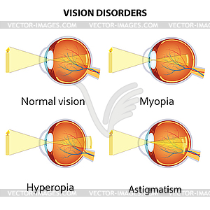 Common vision disorders - vector clip art