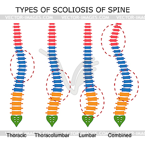 Типы сколиоза позвоночника - клипарт в векторе