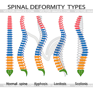 Типы деформаций позвоночника - изображение в векторном виде