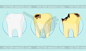 Kind of teeth, clean, caries , flat style - vector clipart