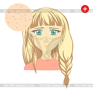 Acne. Problem blackhead - vector clipart